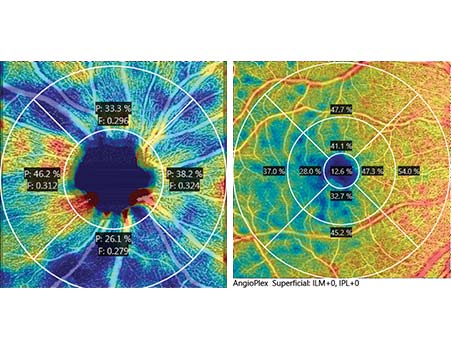 ZEISS AngioPlex OCT Angiography. Making the revolutionary, routine