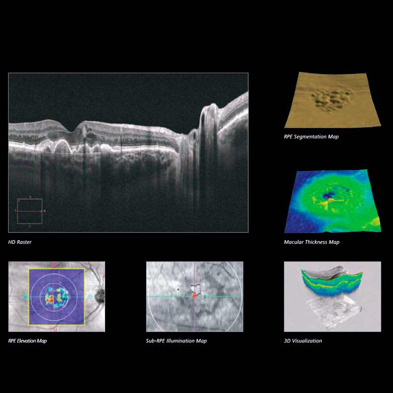 CIRRUS HD-OCT 5000/500 Advancing Smart OCT