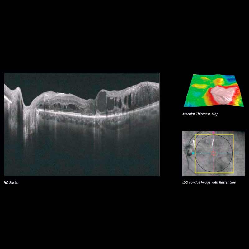 CIRRUS HD-OCT 5000/500 Advancing Smart OCT