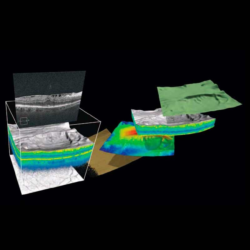 CIRRUS HD-OCT 5000/500 Advancing Smart OCT