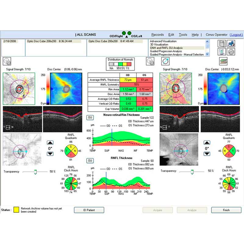 CIRRUS HD-OCT 5000/500 Advancing Smart OCT