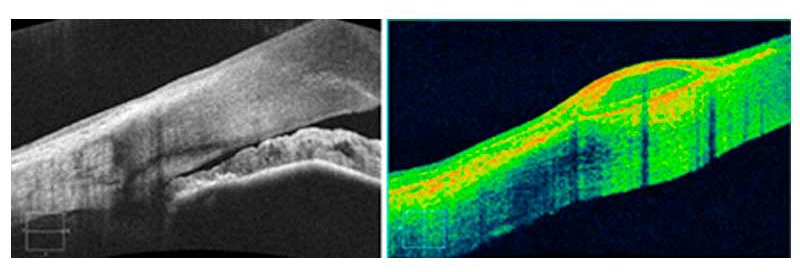 CIRRUS HD-OCT 5000/500 Advancing Smart OCT